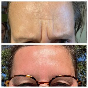 before and after photos - Front Door Medspa&reg; in Rochester, MI