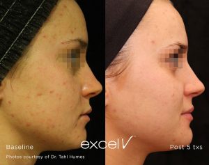 Acne & Rosacea treatment in Rochester, MI