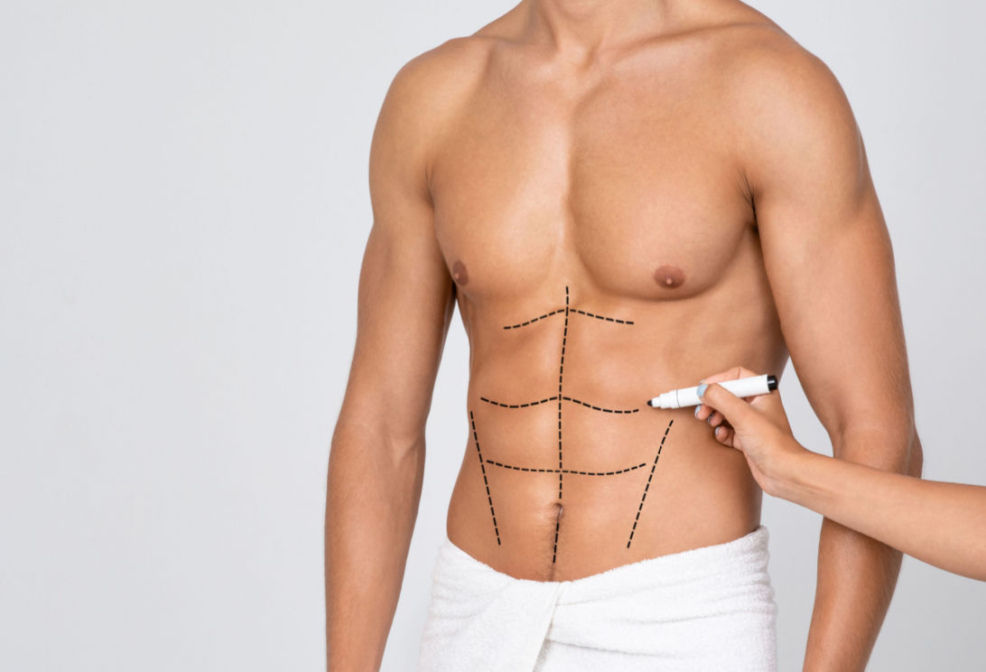 Coolsculpting in Rochester, MI