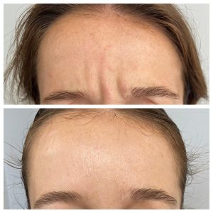 before and after botox in Rochester, MI