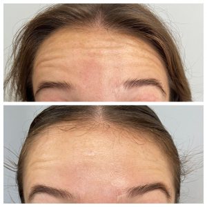 before and after botox in Rochester, MI at Front Door MedSpa