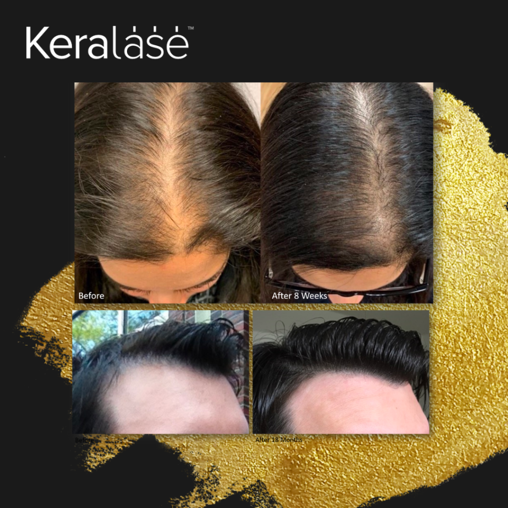 Keralase treatment - before and after in Rochester, MI