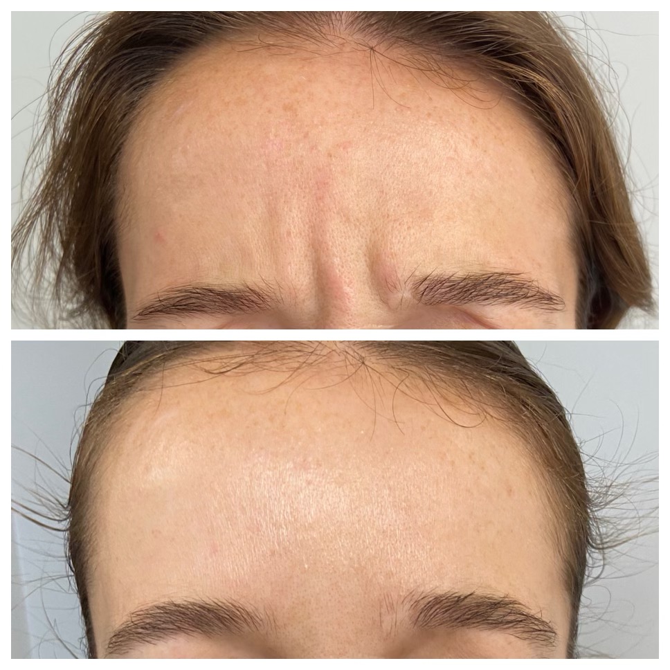 Forehead - Botox in Rochester, MI