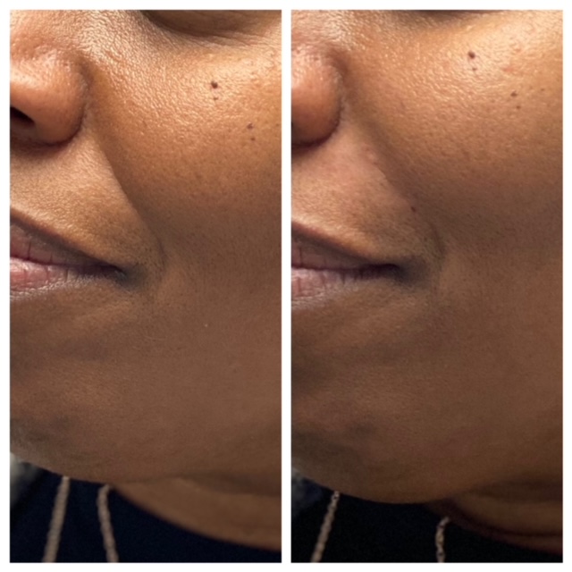 Lower Face fillers in Rochester, MI