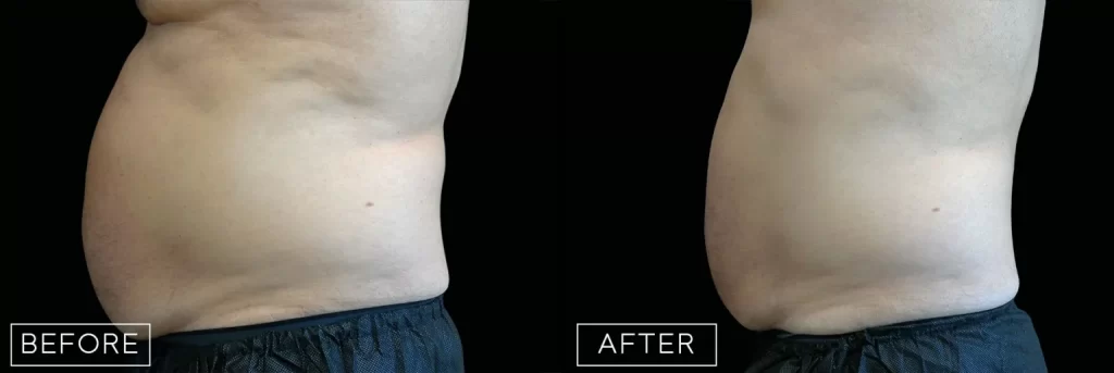 Emsculpt neo - before and after in Rochester, MI