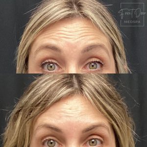 before and after Botox treatment