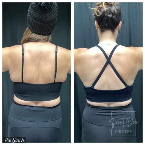 bra fat reduction before/after