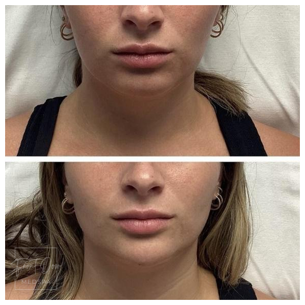 Lower Face fillers in Rochester, MI