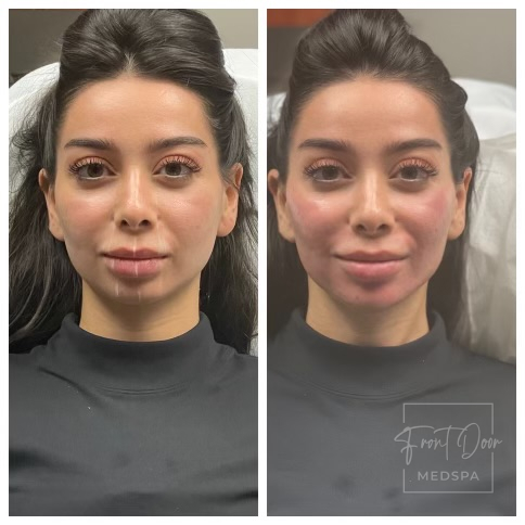 Lower Face fillers in Rochester, MI