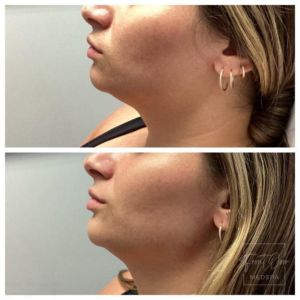 Lower Face fillers in Rochester, MI