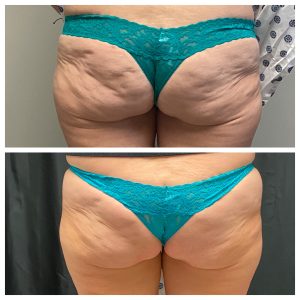 front & center buns before/after