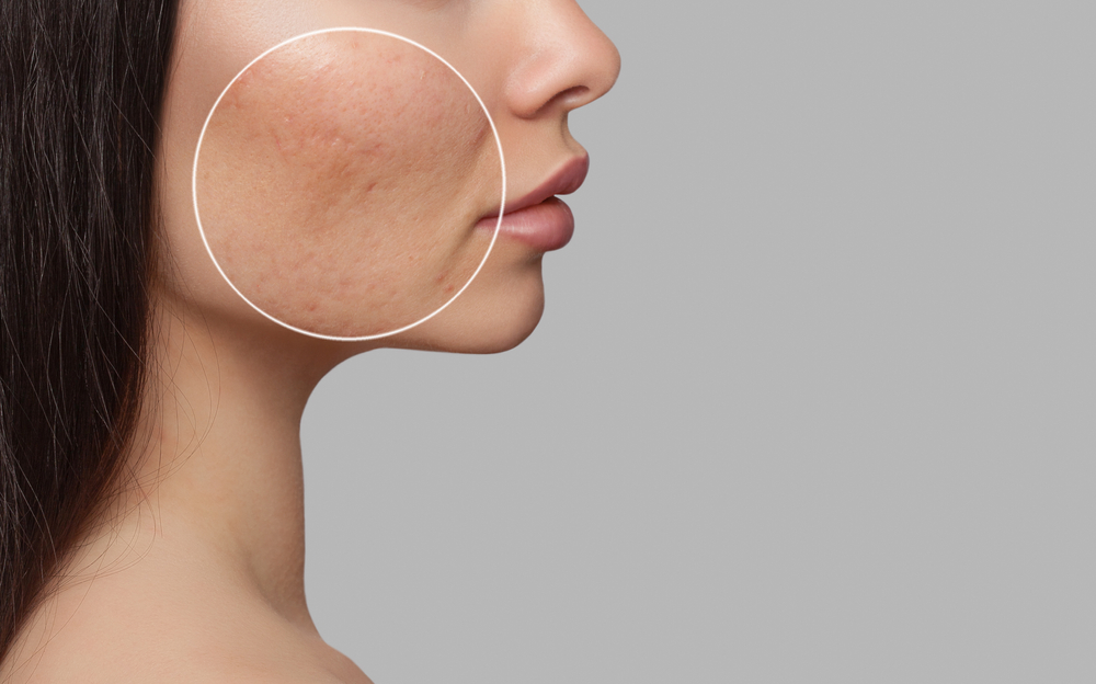 hyperpigmentation on woman's cheek