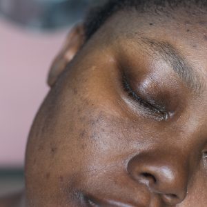 hyperpigmentation on a black woman