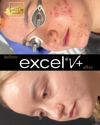 Before and after images showcasing the results of Excel V+ laser treatment for acne, highlighting significant skin improvement and clarity at Front Door Medspa in Rochester, MI.