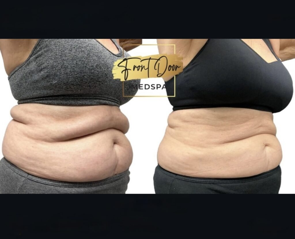 before and after photo of a fat reduction client