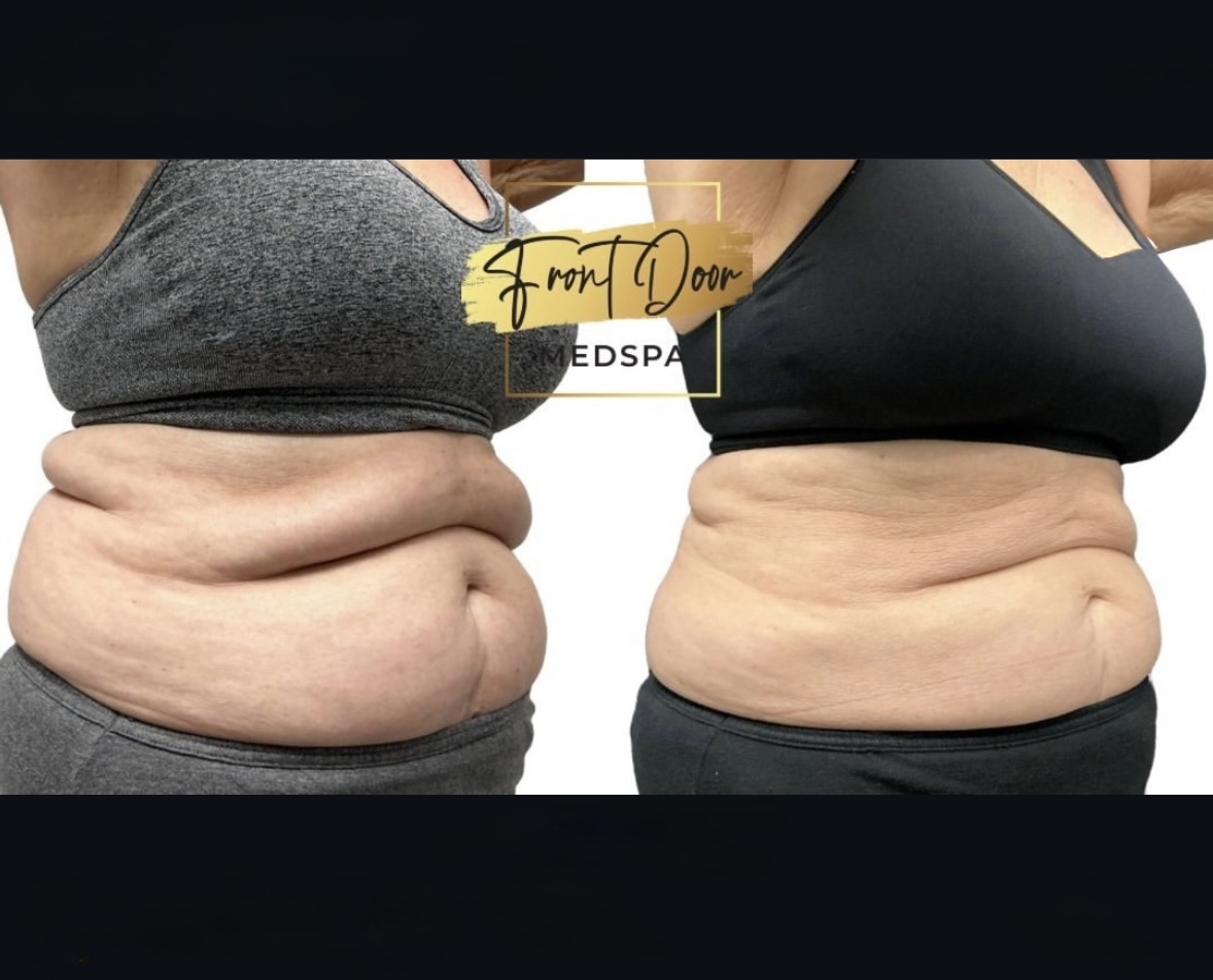 before and after photo of a fat reduction client