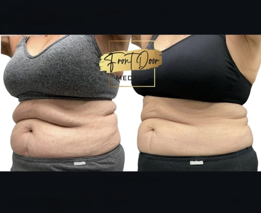 before and after fat reduction client
