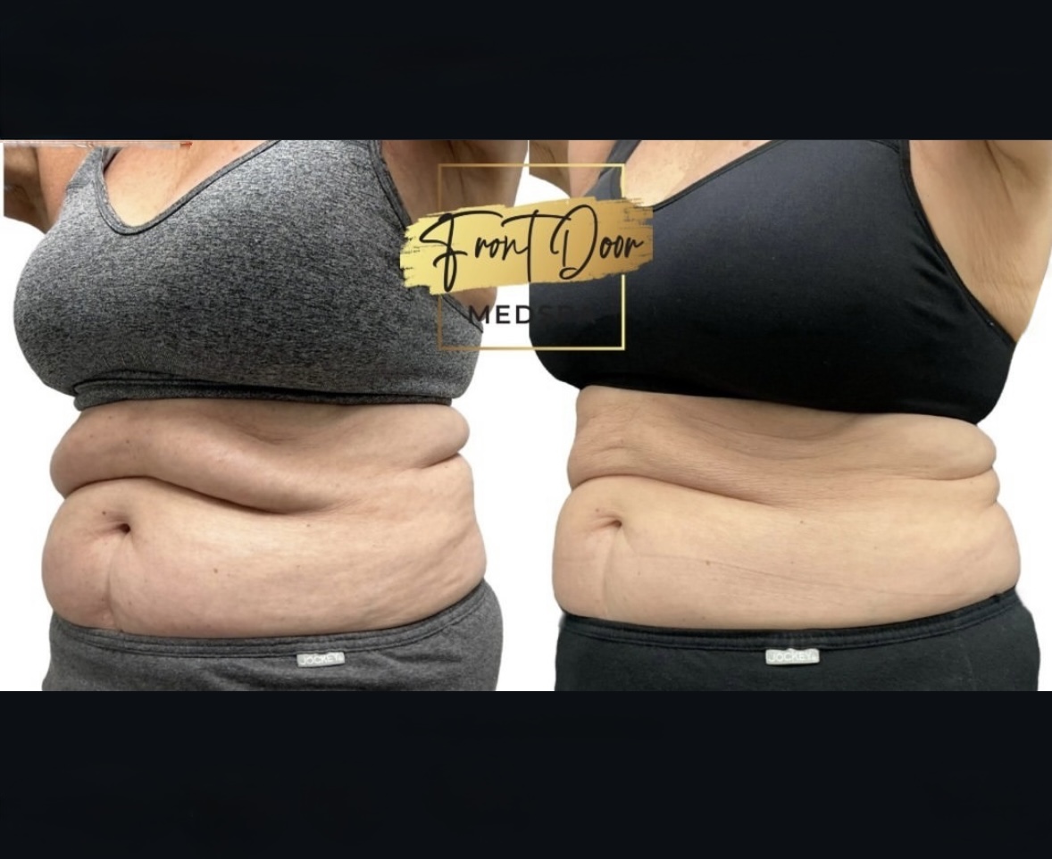 before and after fat reduction client