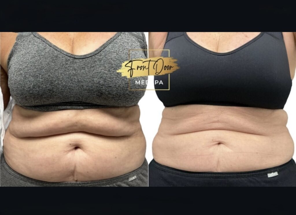 before and after fat reduction