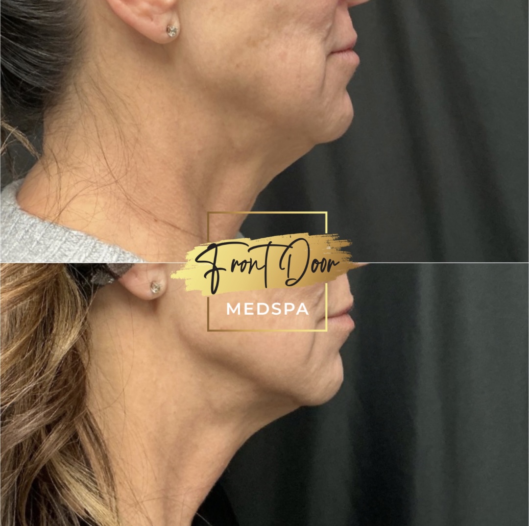 skin tightening before and after