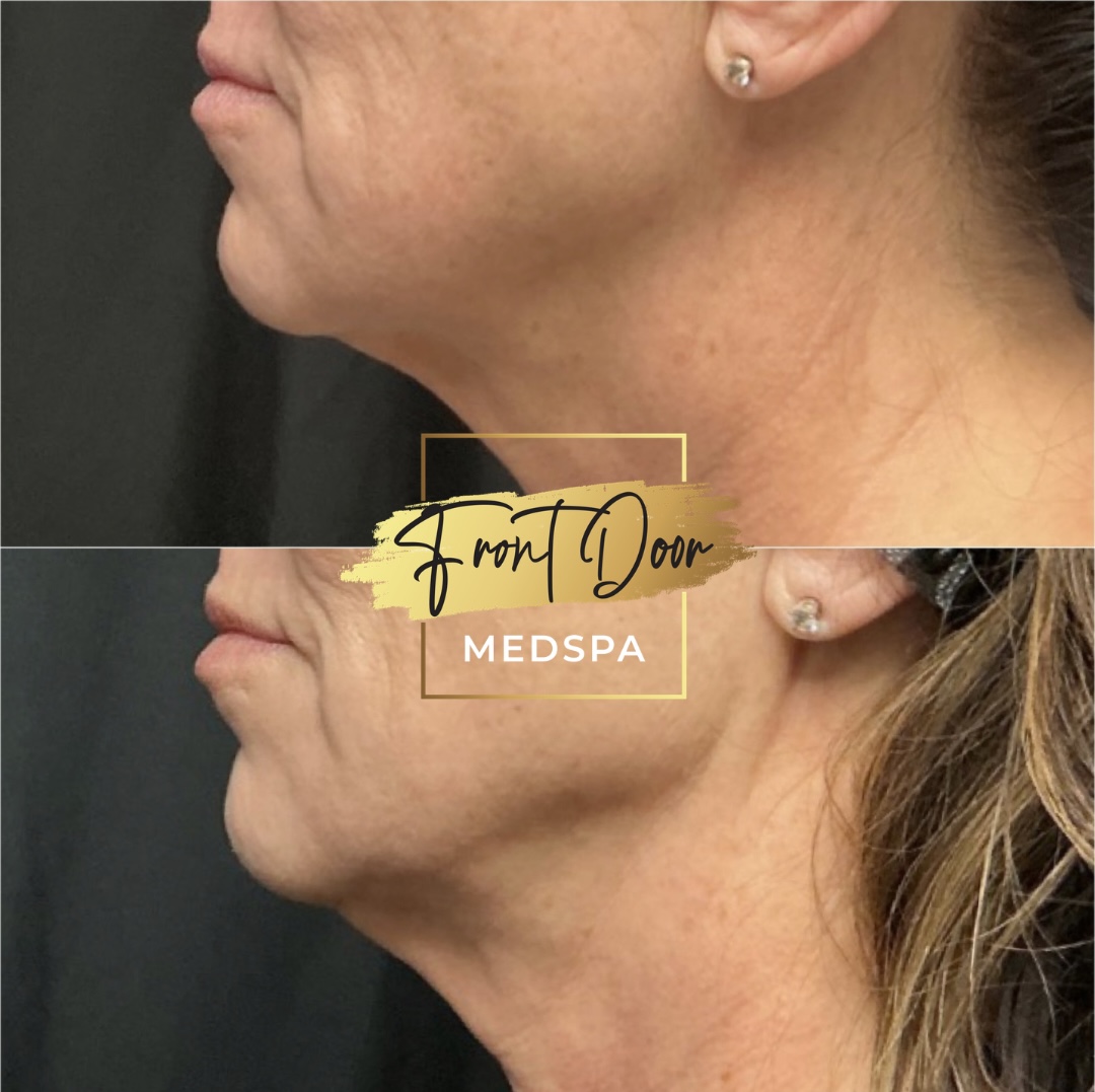 skin tightening reuslts