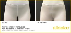 AlloClae before and after