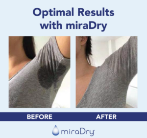 miraDry Before & After